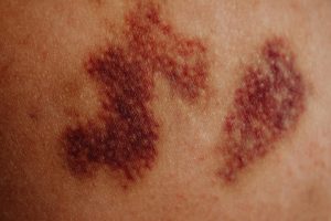 birth-mark